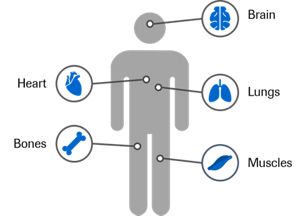diagrams of people with muscular dystrophy