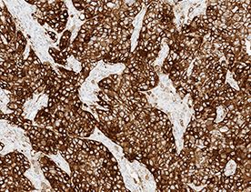 Tinción del ensayo VENTANA PD-L1 (SP263) en el carcinoma urotelial (CU)