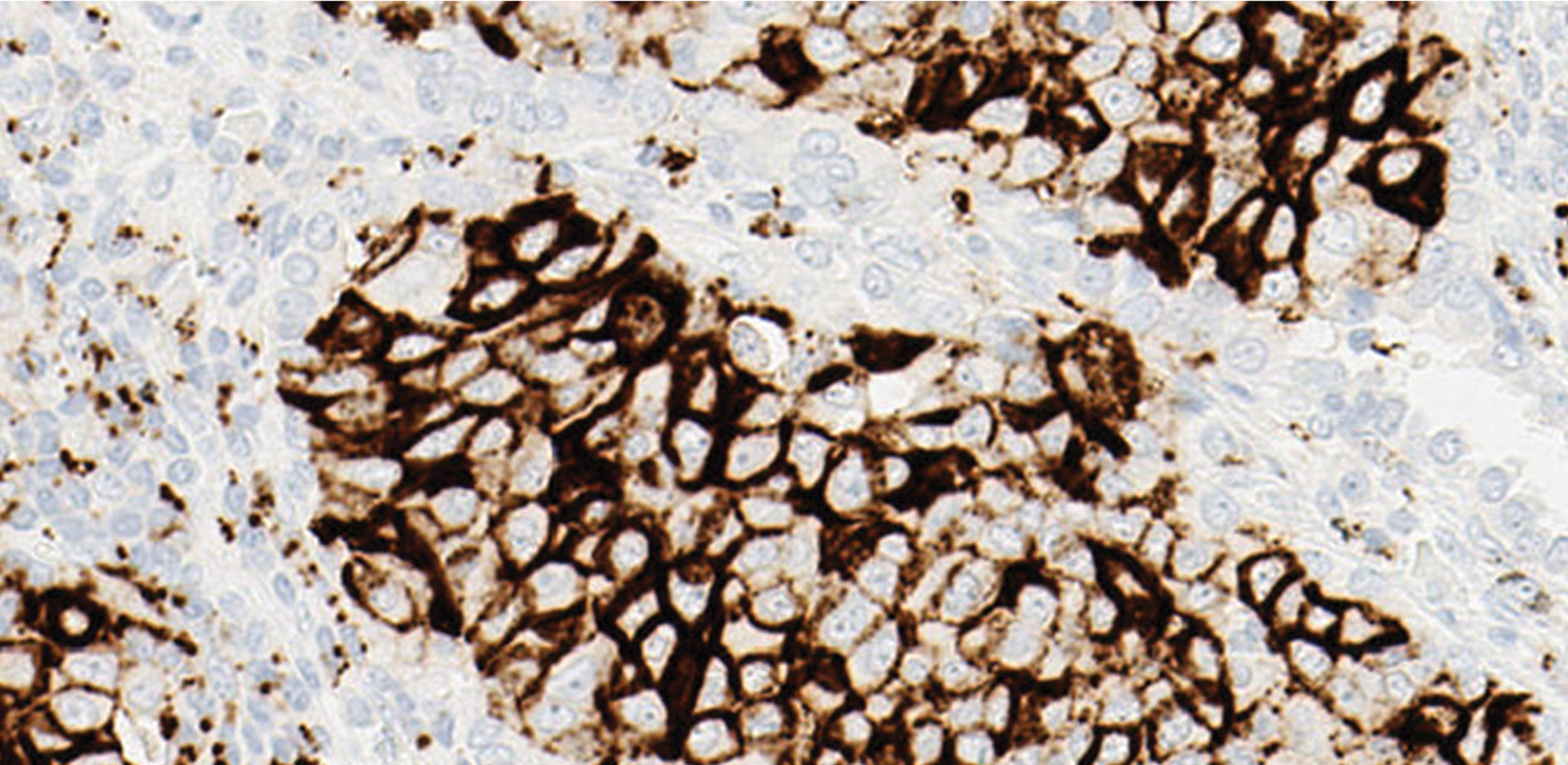 Tejido de cáncer de pulmón no microcítico (CPNM) positivo teñido con ensayo de PD-L1 (SP142)