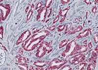 Muestras de carcinoma de próstata teñidas con anticuerpo primario monoclonal de conejo anti-p504s (SP116)