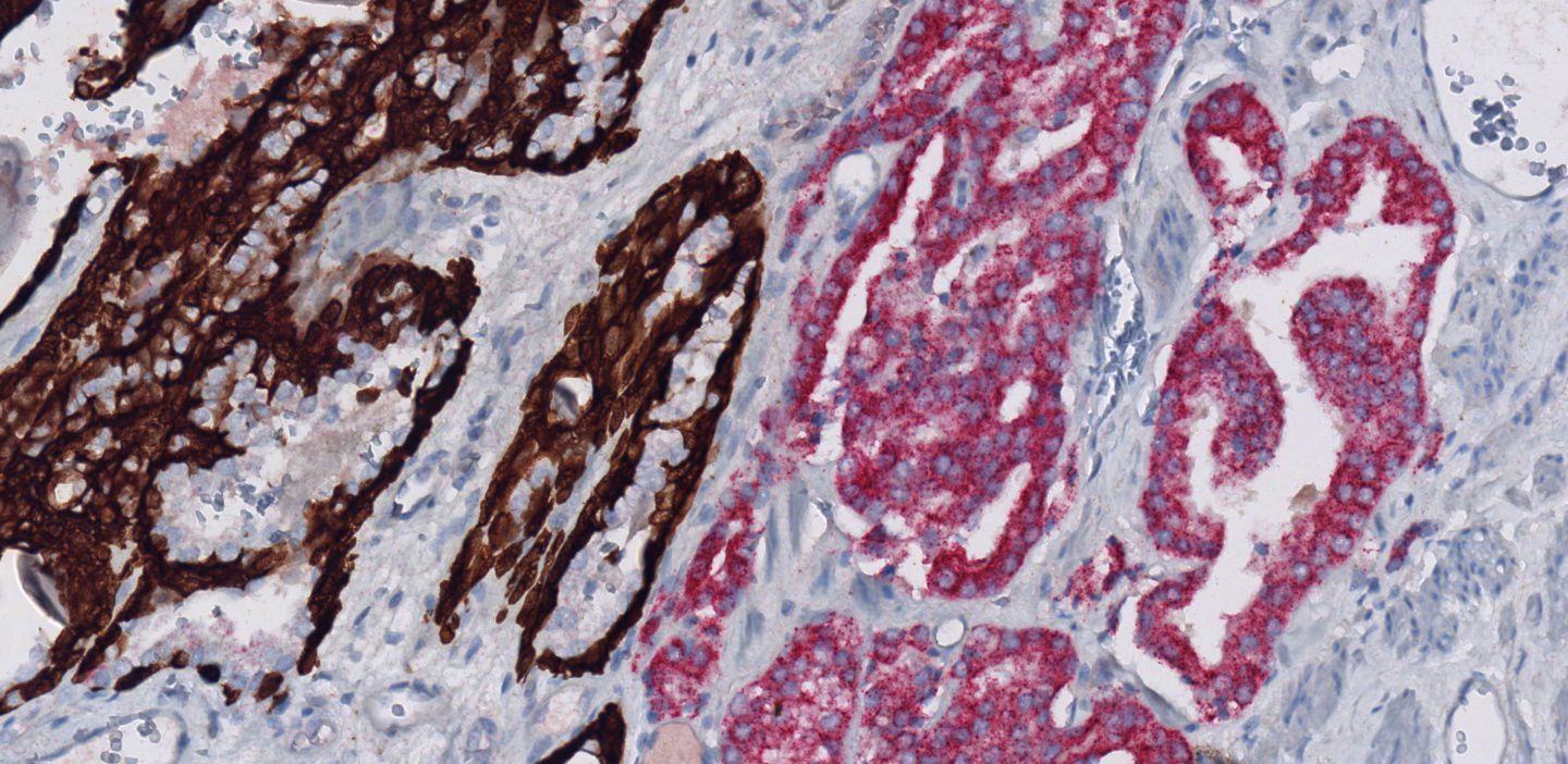 Muestras de carcinoma de próstata teñidas con anticuerpo primario monoclonal de conejo anti-p504s (SP116)
