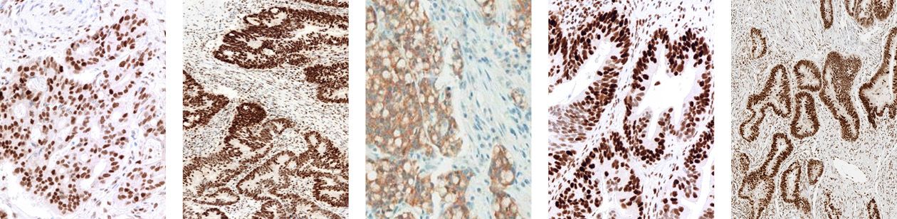 Tinción positiva para el cáncer colorrectal con el panel VENTANA MMR IHC