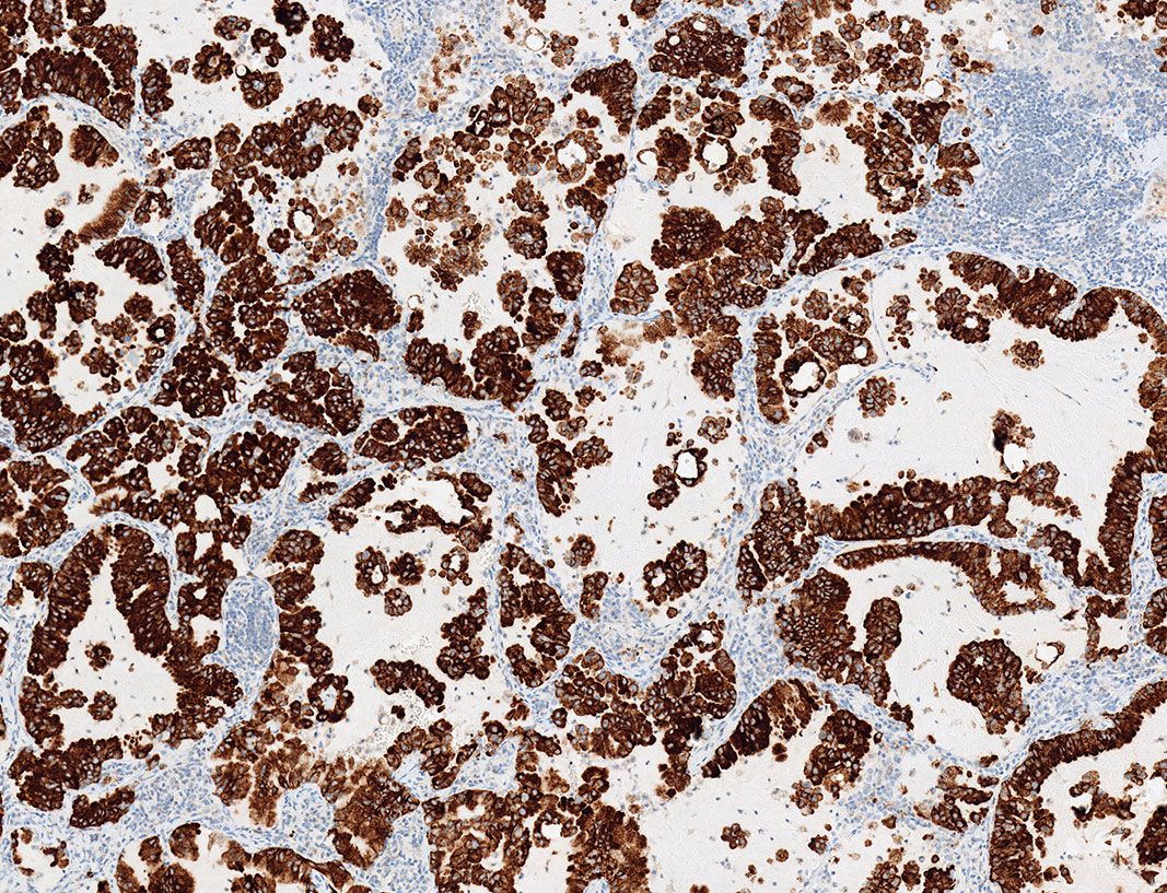 Tejido de carcinoma pulmonar no microcítico teñido con la prueba VENTANA ALK (D5F3) CDx y con y detección y amplificación OptiView DAB
