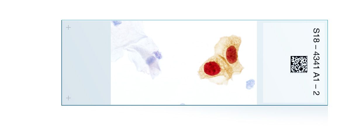 CINtec® PLUS uses an immunocytologic dual stain, to look for the simultaneous presence of biomarkers p16 and Ki-67