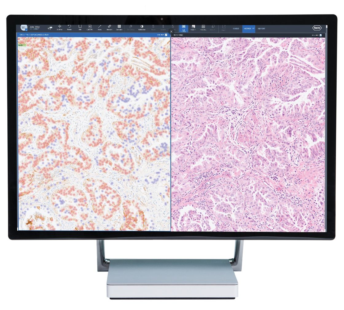 Thumbnail view of Roche uPath PD-L1 (SP263) whole slide image analysis, NSCLC (CE-IVD)