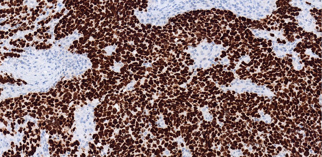 Coloration immunohistochimique des cellules basales (34&szlig;E12 + p63)