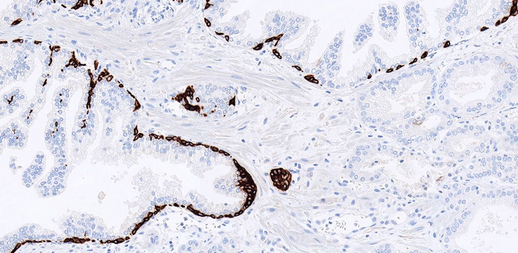 immunohistochemical staining with Basal Cell Cocktail 34ßE12 + p63