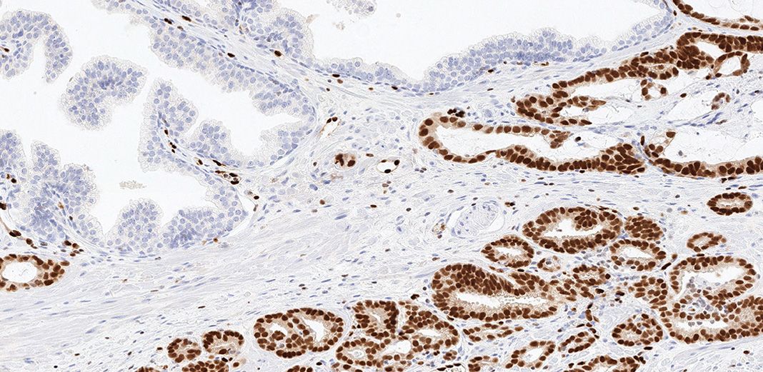 prostate adenocarcinoma immunohistochemistry