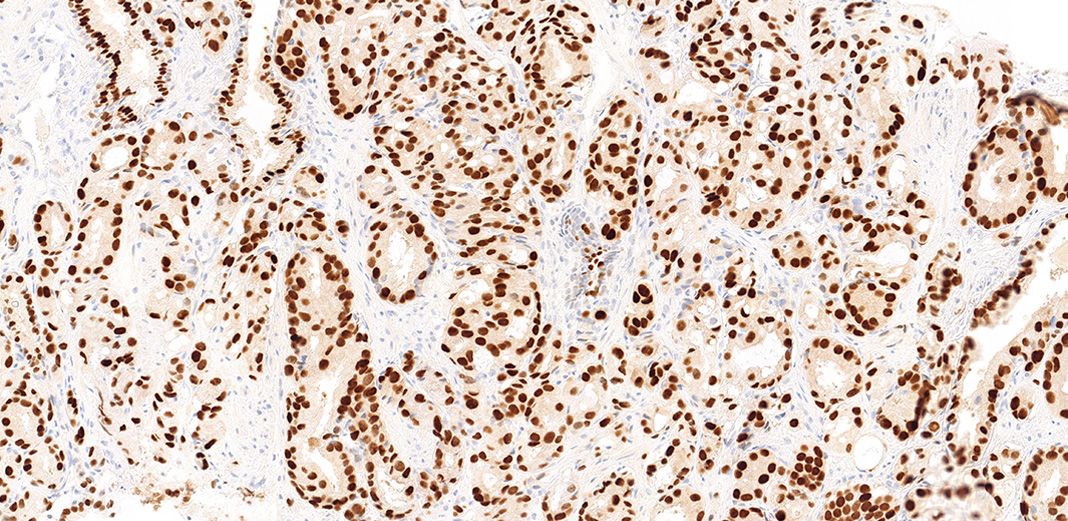 Changes of protein expression in prostate cancer having lost its androgen sensitivity.