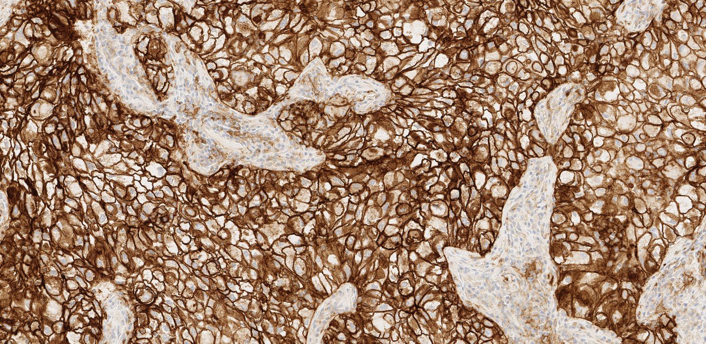 VENTANA PD-L1 (SP263) Testi, küçük hücreli dışı akciğer kanseri (KHDAK), ürotelyal karsinom, mesane kanseri
