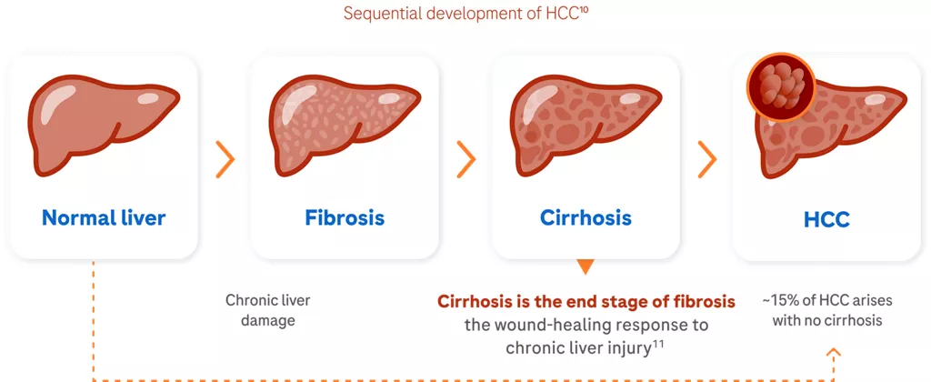 Diagram showing the development of hepatocellular carcinoma, as chronic liver disease damage leads to cirrhosis and then to HCC.